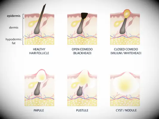 Her viser vi dig, hvordan du hurtigt og effektivt kan slippe af med din acne